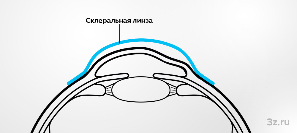 Принцип работы склеральной линзы